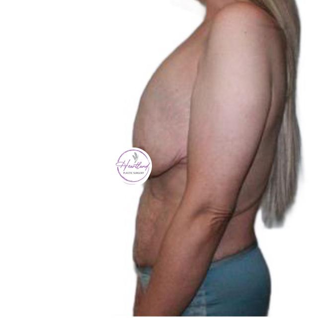 Mommy Makeover before at Dr. Nataliya Biskup in Wichita, KS