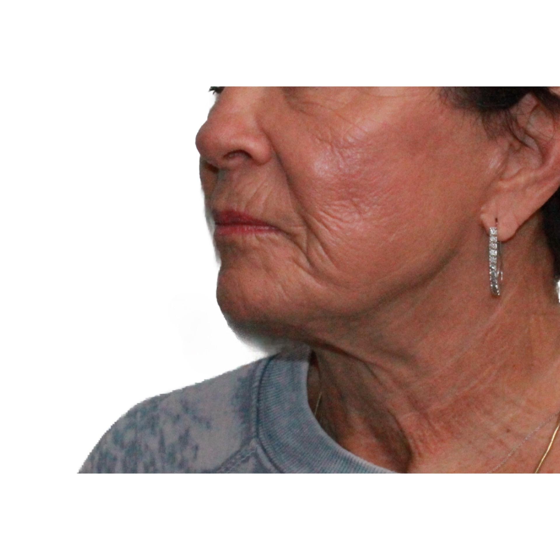 Dr. Nataliya Biskup facelift after — Wichita, KS