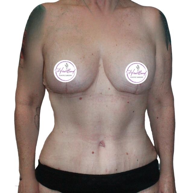 Mommy Makeover after at Dr. Nataliya Biskup in Wichita, KS