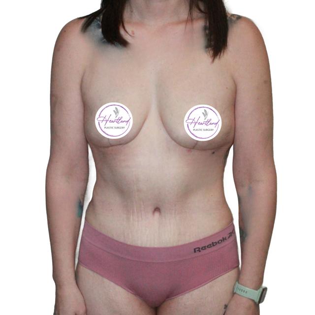 Mommy Makeover after at Dr. Nataliya Biskup in Wichita, KS