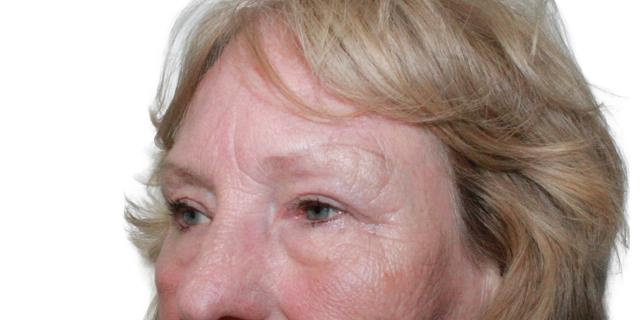 Blepharoplasty after at Dr. Nataliya Biskup in Wichita, KS