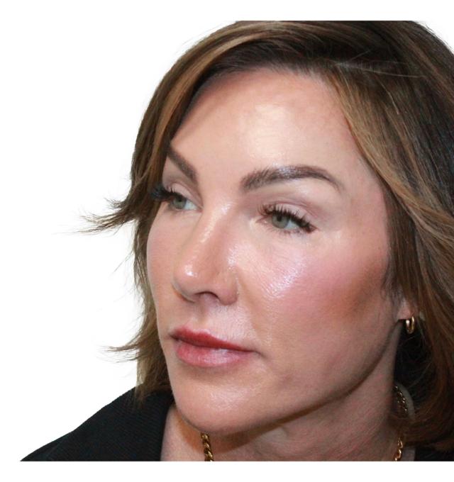 Blepharoplasty after at Dr. Nataliya Biskup in Wichita, KS