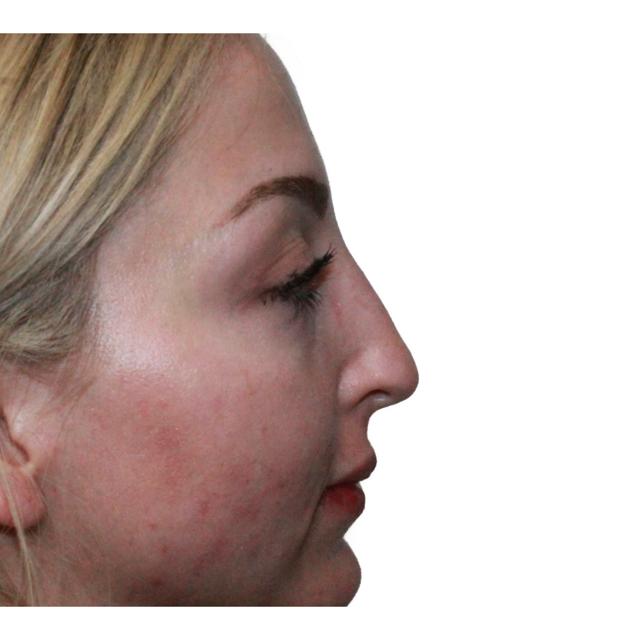 Functional Rhinoplasty before at Dr. Nataliya Biskup in Wichita, KS