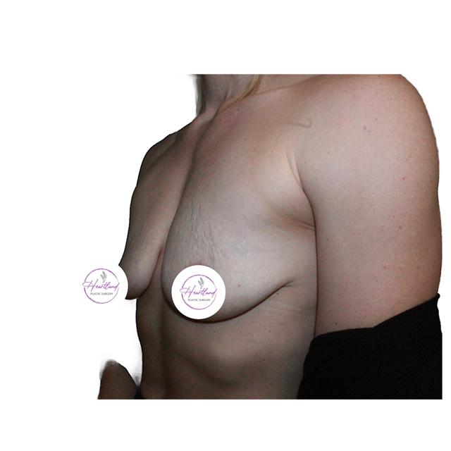 Breast Lift before at Dr. Nataliya Biskup in Wichita, KS