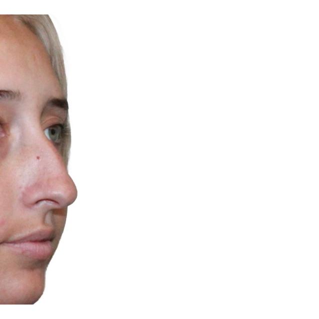 Functional Rhinoplasty before at Dr. Nataliya Biskup in Wichita, KS