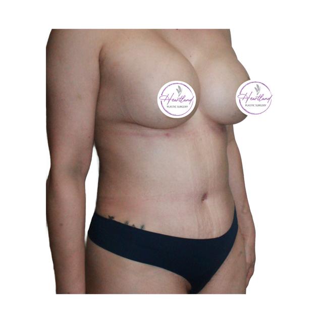 Mini Tummy Tuck after at Dr. Nataliya Biskup in Wichita, KS
