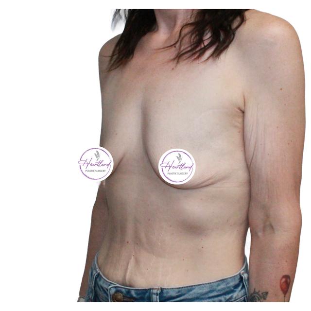 Fat Transfer Breast Augmentation before at Dr. Nataliya Biskup in Wichita, KS