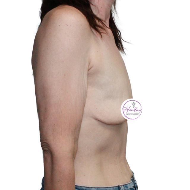 Fat Transfer Breast Augmentation before at Dr. Nataliya Biskup in Wichita, KS