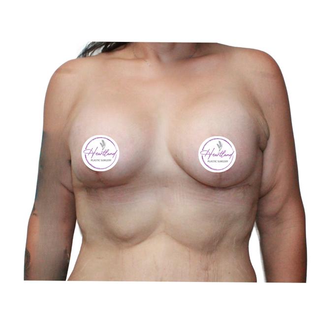 Breast Lift after at Dr. Nataliya Biskup in Wichita, KS