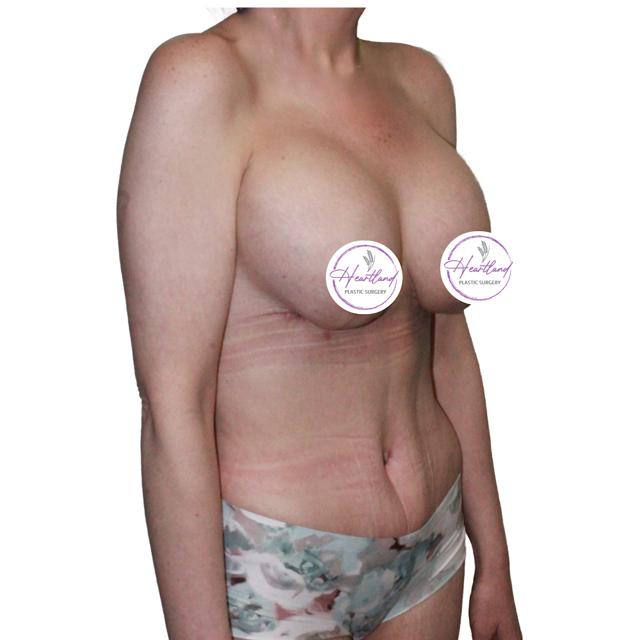 Mommy Makeover after at Dr. Nataliya Biskup in Wichita, KS