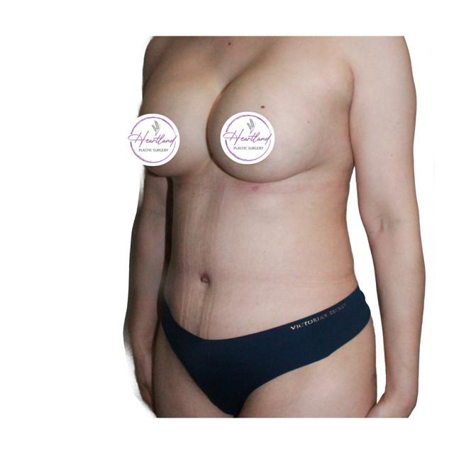 Mini Tummy Tuck after at Dr. Nataliya Biskup in Wichita, KS