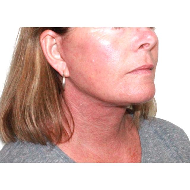 Neck Lift after at Dr. Nataliya Biskup in Wichita, KS