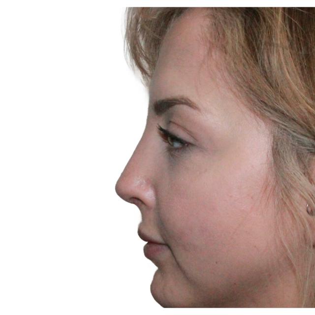 Functional Rhinoplasty after at Dr. Nataliya Biskup in Wichita, KS