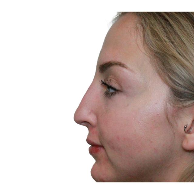 Functional Rhinoplasty before at Dr. Nataliya Biskup in Wichita, KS