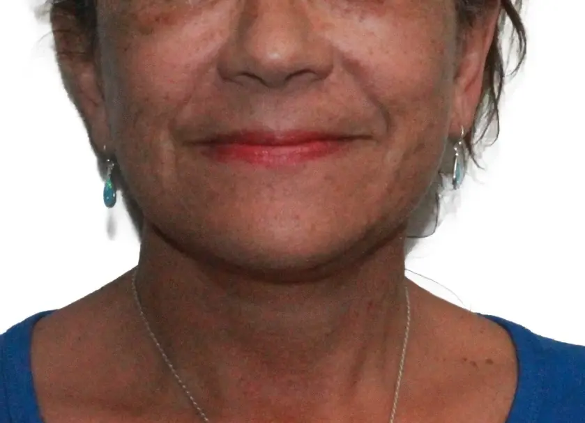 Dr. Nataliya Biskup facelift after — Wichita, KS