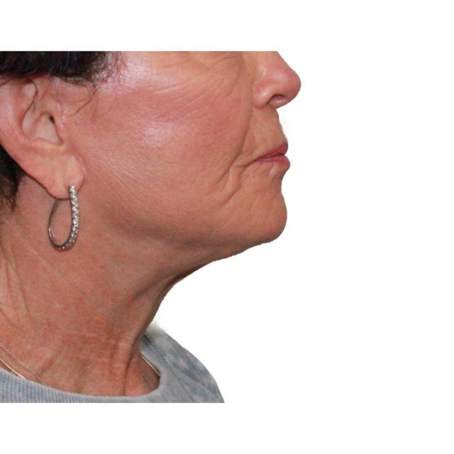 Facelift after at Dr. Nataliya Biskup in Wichita, KS