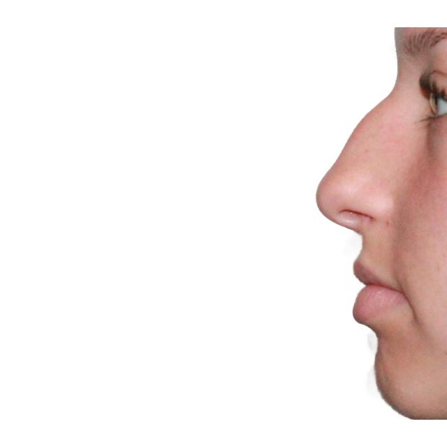 Functional Rhinoplasty before at Dr. Nataliya Biskup in Wichita, KS