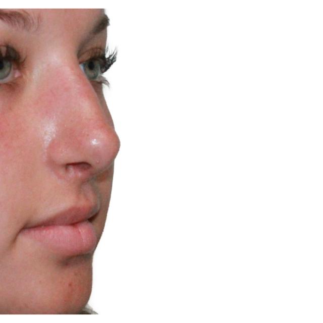 Functional Rhinoplasty after at Dr. Nataliya Biskup in Wichita, KS