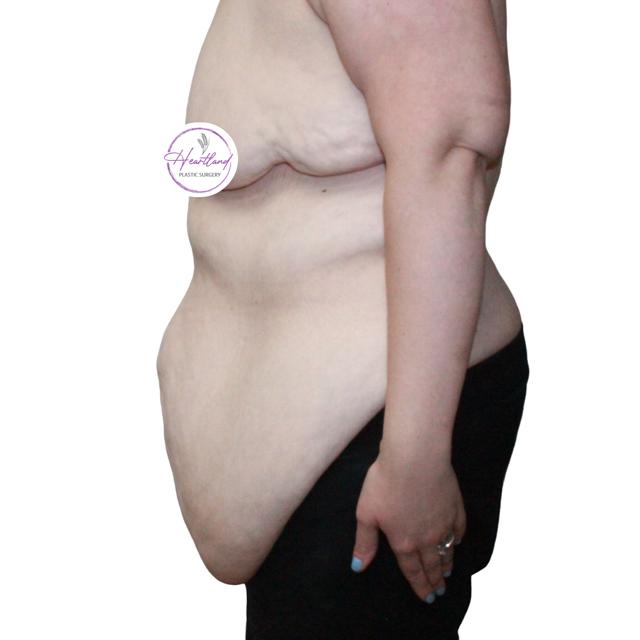Mini Tummy Tuck before at Dr. Nataliya Biskup in Wichita, KS