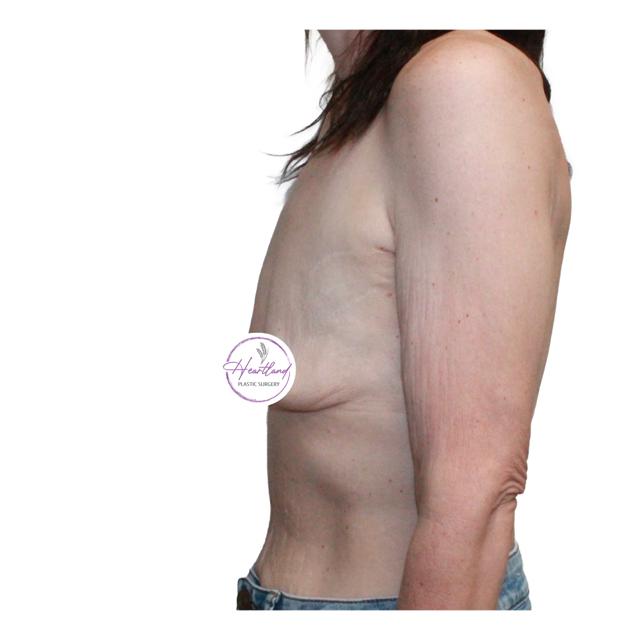Fat Transfer Breast Augmentation before at Dr. Nataliya Biskup in Wichita, KS