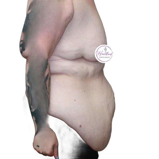 Mini Tummy Tuck before at Dr. Nataliya Biskup in Wichita, KS