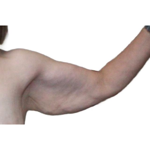 Arm Lift before at Dr. Nataliya Biskup in Wichita, KS