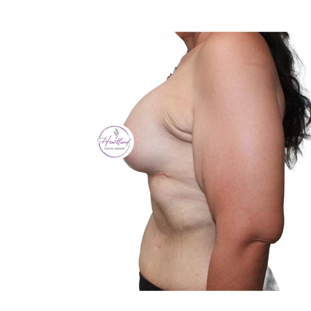 Breast Lift after at Dr. Nataliya Biskup in Wichita, KS