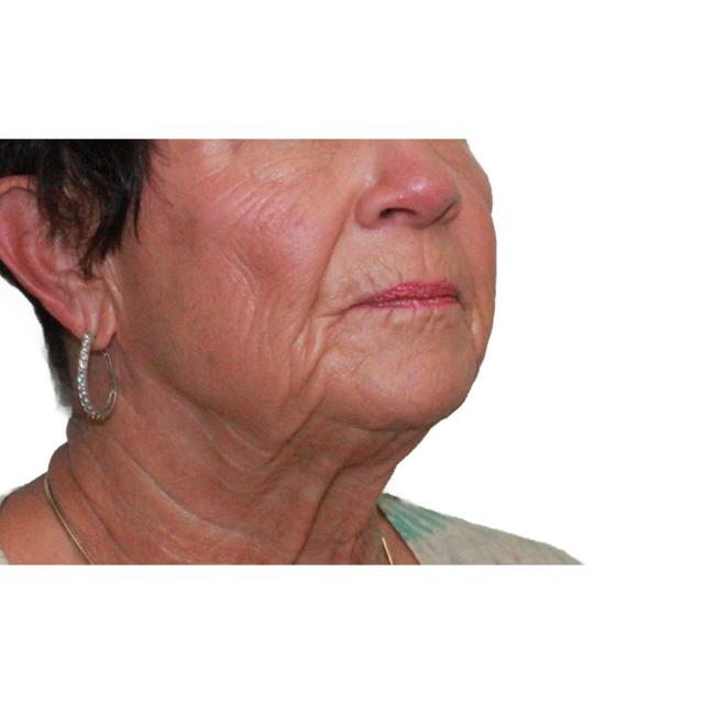 Facelift before at Dr. Nataliya Biskup in Wichita, KS