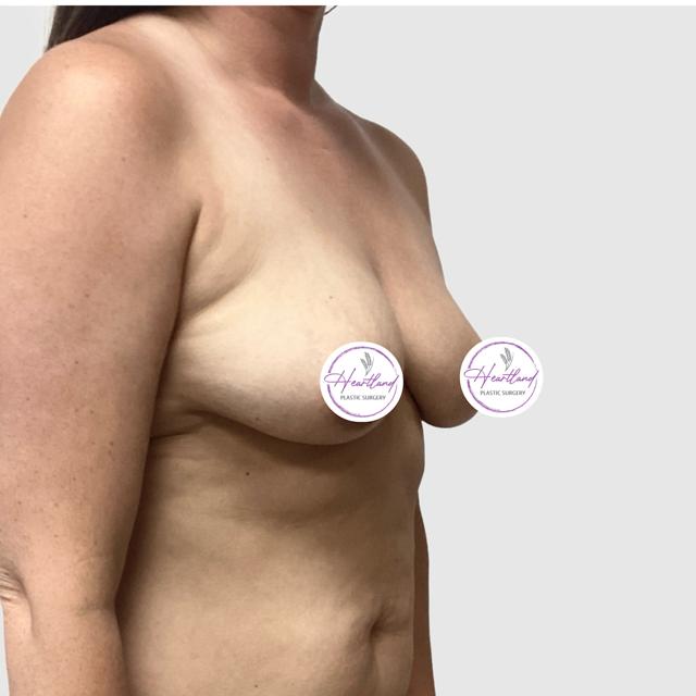 Fat Transfer Breast Augmentation before at Dr. Nataliya Biskup in Wichita, KS