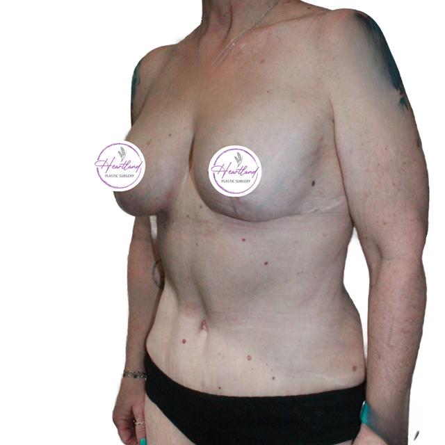 Mommy Makeover after at Dr. Nataliya Biskup in Wichita, KS