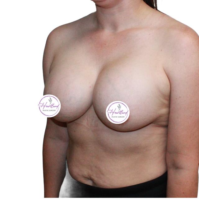 Fat Transfer Breast Augmentation after at Dr. Nataliya Biskup in Wichita, KS