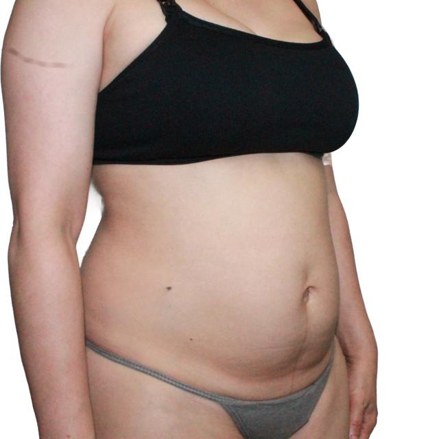 Mini Tummy Tuck before at Dr. Nataliya Biskup in Wichita, KS