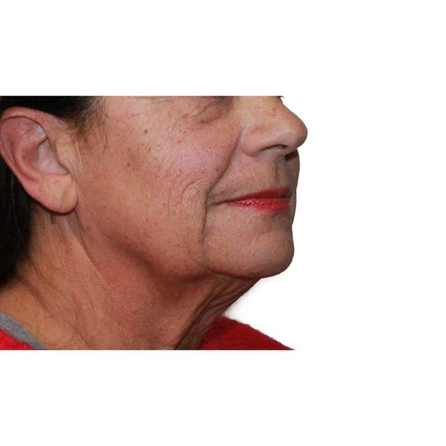 Facelift before at Dr. Nataliya Biskup in Wichita, KS