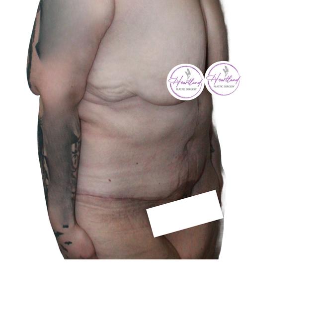 Mini Tummy Tuck after at Dr. Nataliya Biskup in Wichita, KS