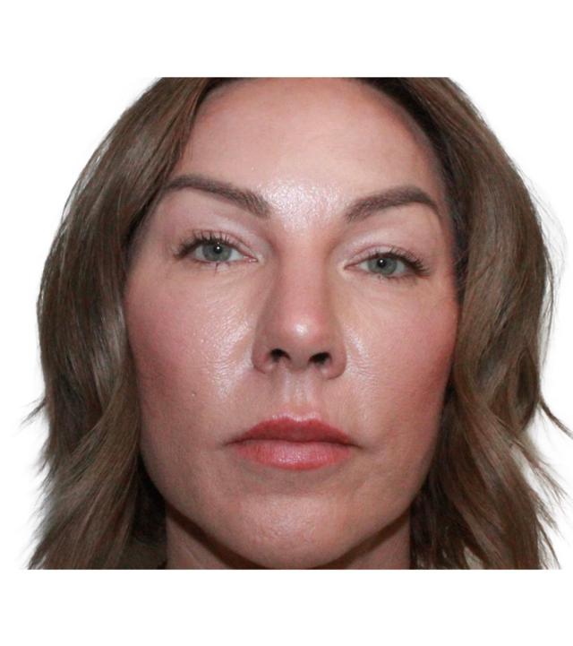 Blepharoplasty before at Dr. Nataliya Biskup in Wichita, KS