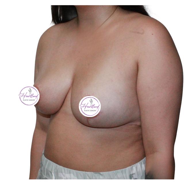 Breast Reduction after at Dr. Nataliya Biskup in Wichita, KS