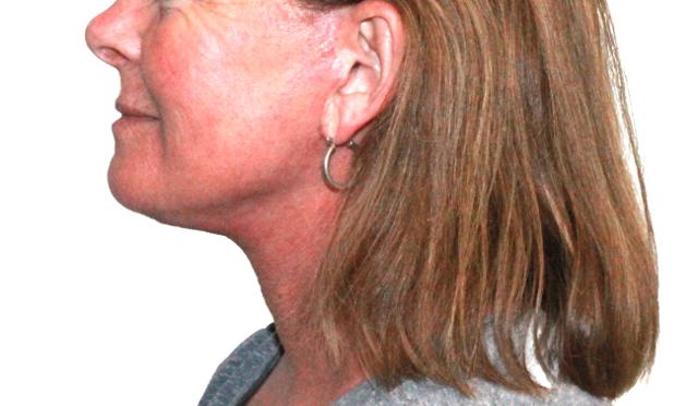 Neck Lift after at Dr. Nataliya Biskup in Wichita, KS