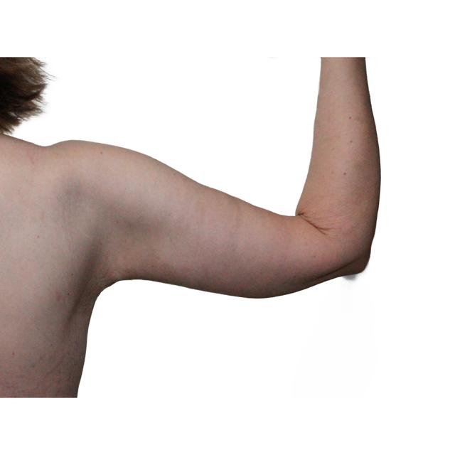 Arm Lift after at Dr. Nataliya Biskup in Wichita, KS