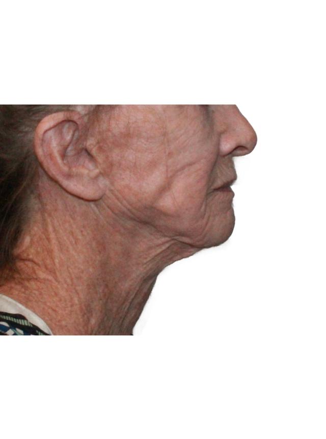 Facelift before at Dr. Nataliya Biskup in Wichita, KS
