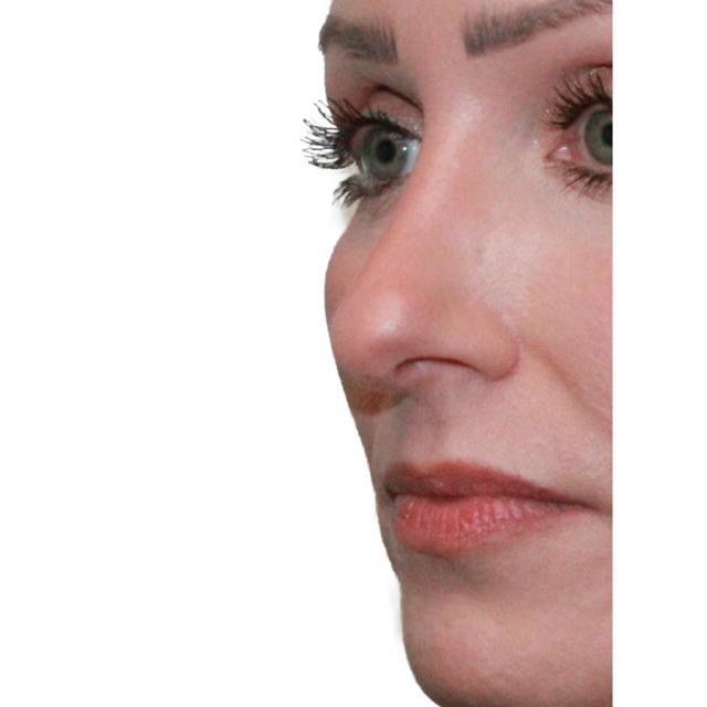 Functional Rhinoplasty before at Dr. Nataliya Biskup in Wichita, KS