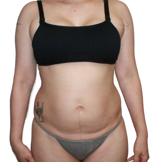 Mini Tummy Tuck before at Dr. Nataliya Biskup in Wichita, KS