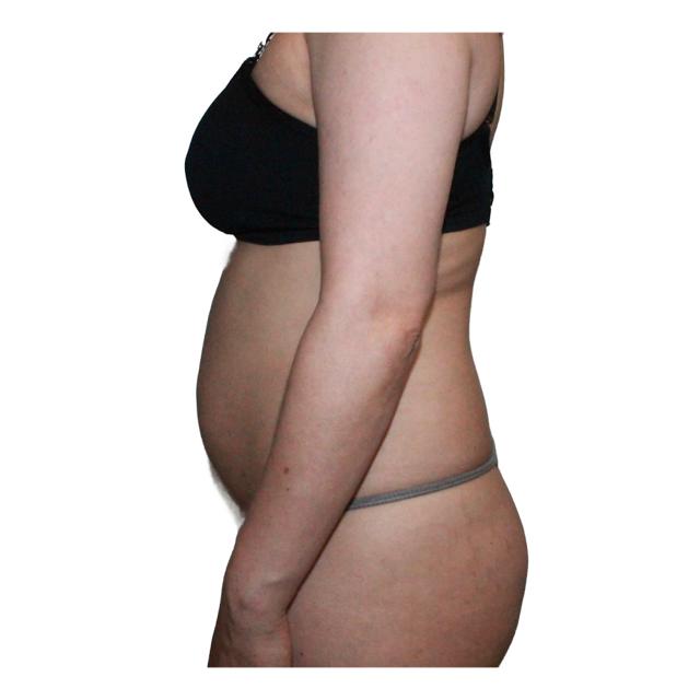 Mini Tummy Tuck before at Dr. Nataliya Biskup in Wichita, KS