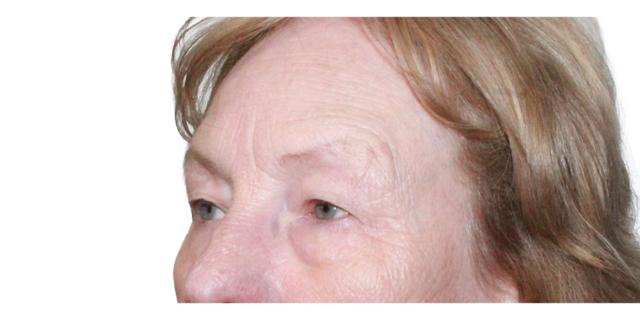 Blepharoplasty before at Dr. Nataliya Biskup in Wichita, KS