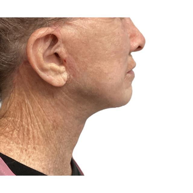 Facelift after at Dr. Nataliya Biskup in Wichita, KS