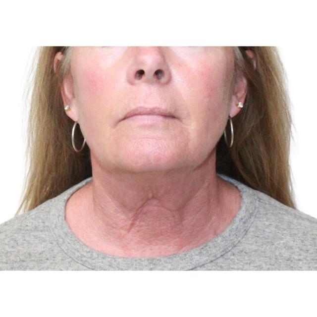 Neck Lift before at Dr. Nataliya Biskup in Wichita, KS