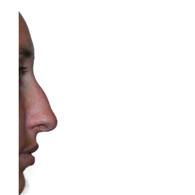 Ethnic Rhinoplasty before at Dr. Nataliya Biskup in Wichita, KS
