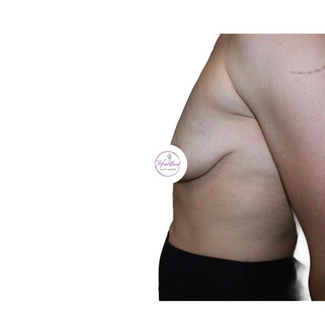 Breast Lift before at Dr. Nataliya Biskup in Wichita, KS