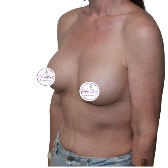 Fat Transfer Breast Augmentation after at Dr. Nataliya Biskup in Wichita, KS
