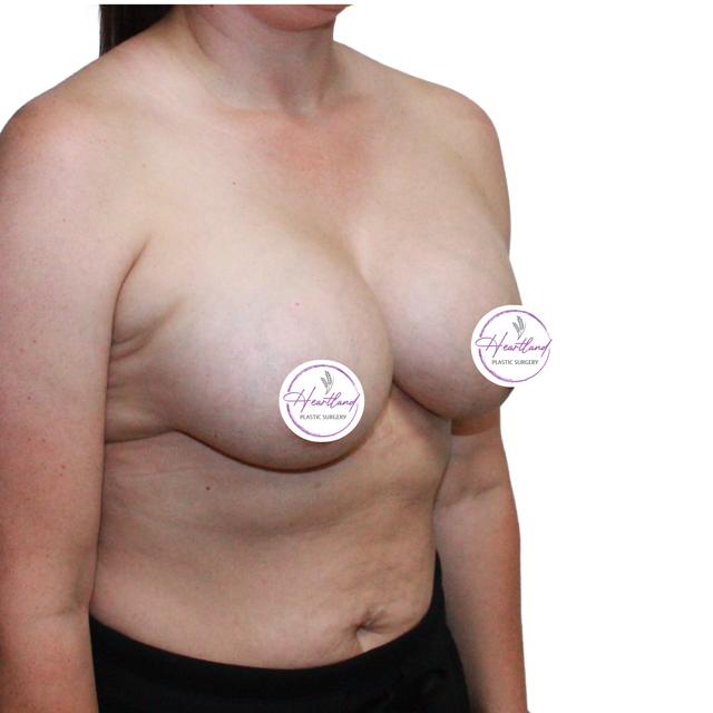Fat Transfer Breast Augmentation after at Dr. Nataliya Biskup in Wichita, KS