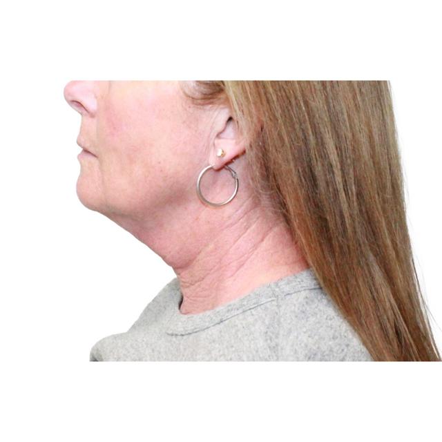 Neck Lift before at Dr. Nataliya Biskup in Wichita, KS